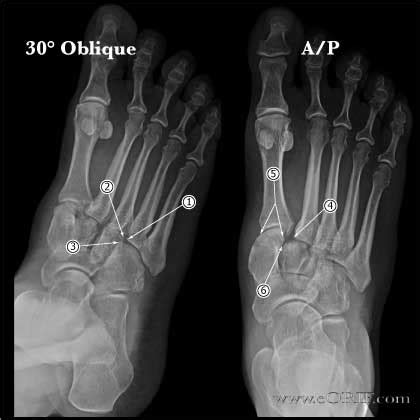 right ankle fracture icd 10